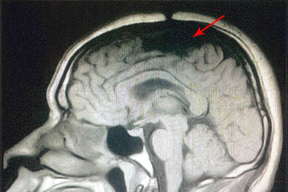 A scan of Ernest John’s brain shows a hole in his skull and brain missing, from an affidavit of Dr. Joel Zivot.